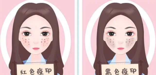 臉上紅色痘印幾個(gè)月都不消怎么辦？紅色痘印應(yīng)該怎么消除？